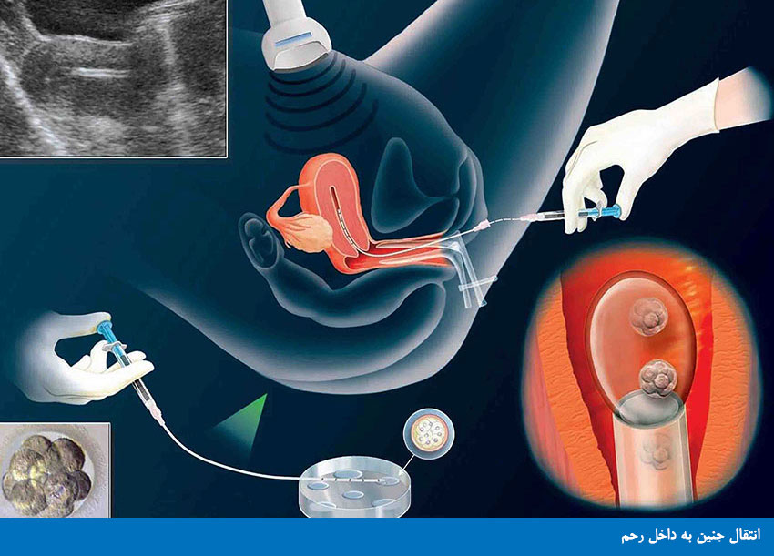 دستورات دارويي بعد از عمل تخمك كشي opu